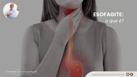 esofagite não erosiva